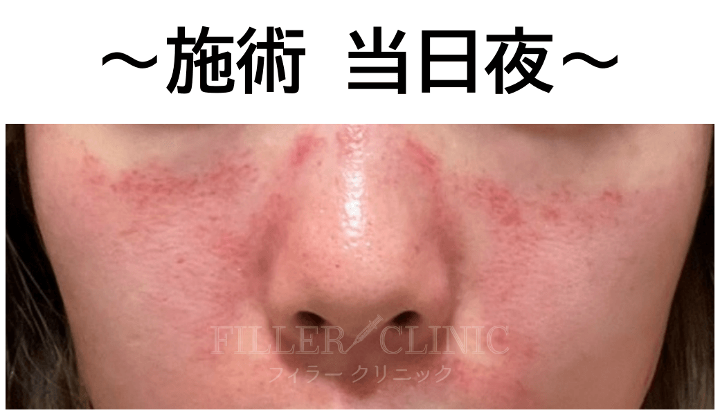 施術 当日夜