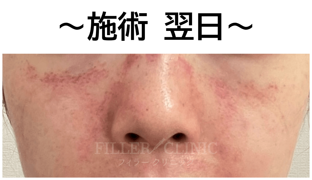 施術 翌日